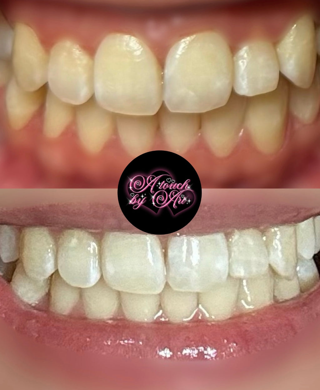 Teeth Whitening Appointment